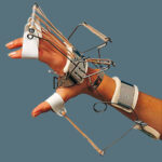 Ferula dr. Bunnel per polso e mano (estensione polso, metacarpi e dita - abduzione pollice) - Ro+Ten Splint PR213A